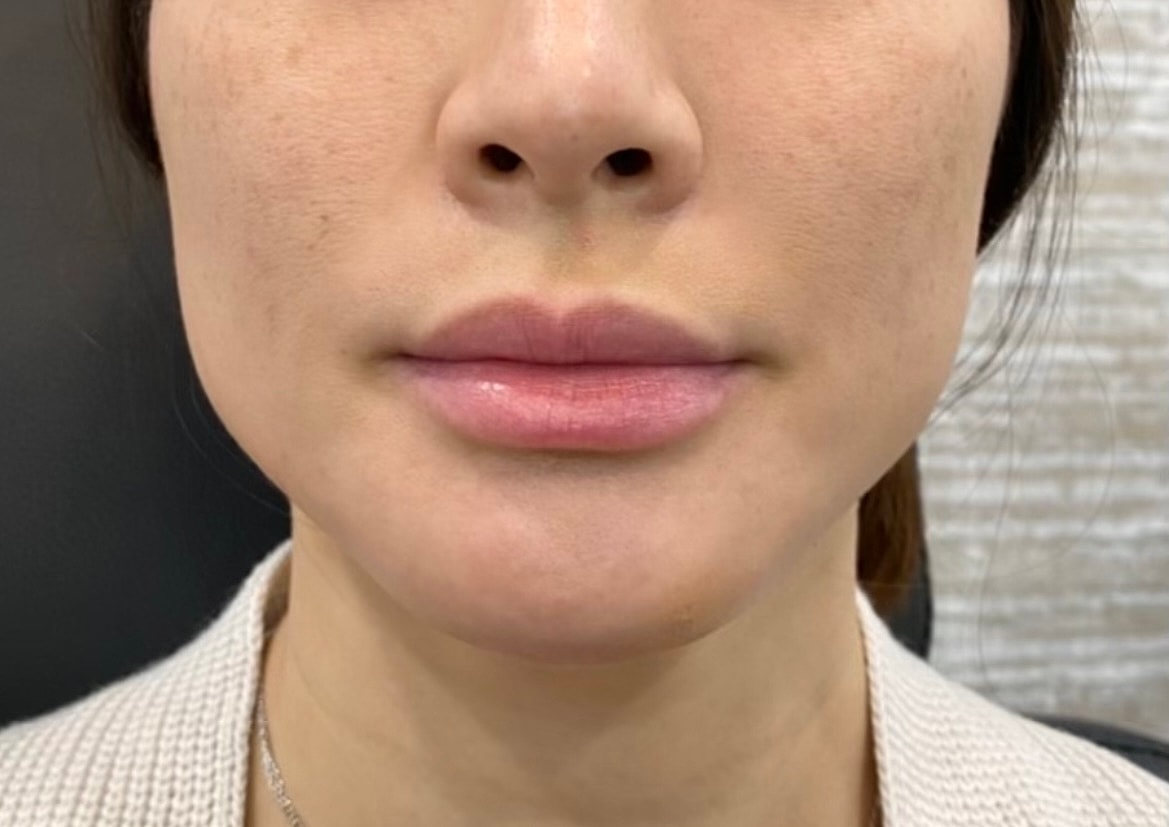 Dermal Fillers Before & After