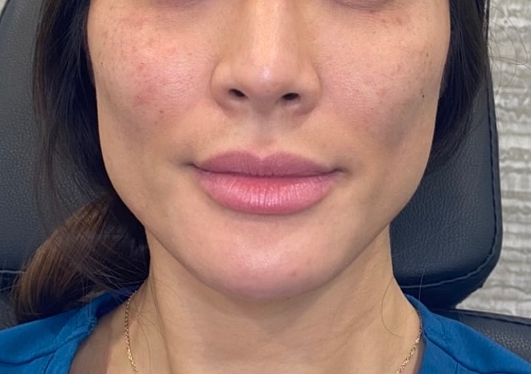 Dermal Fillers Before & After