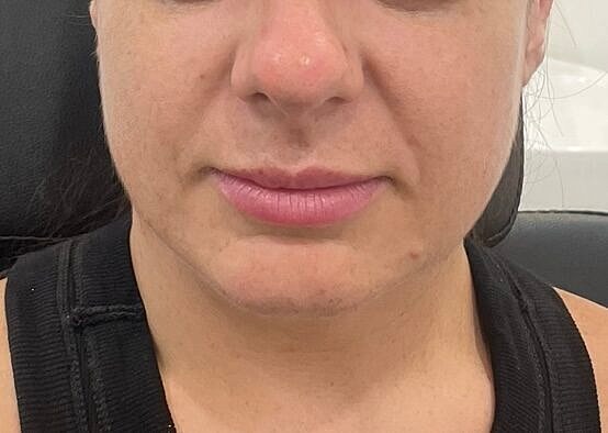 Dermal Fillers Before & After
