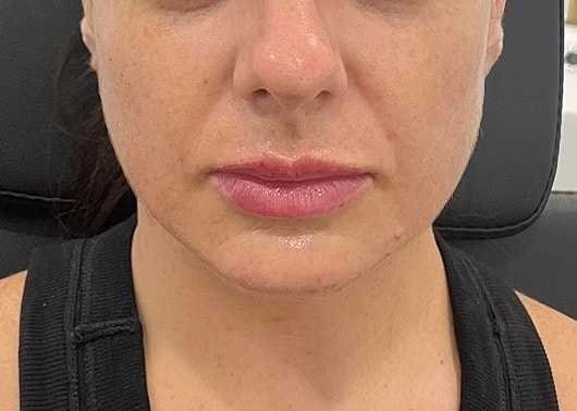 Dermal Fillers Before & After