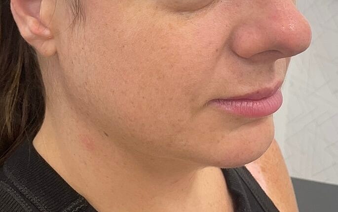 Dermal Fillers Before & After