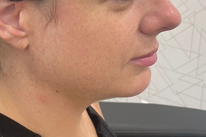 Dermal Fillers Before & After