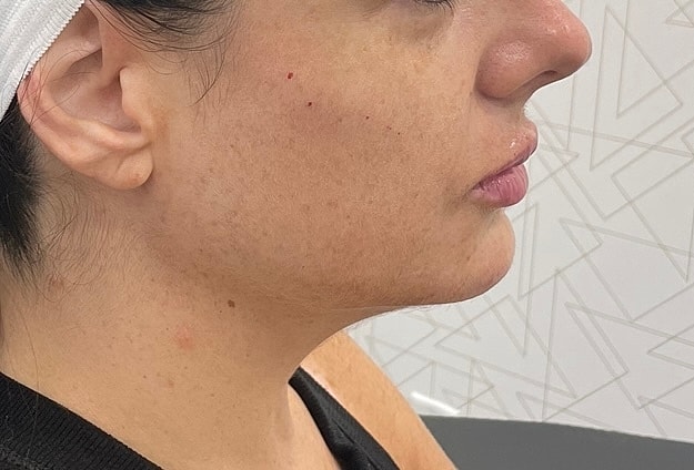 Dermal Fillers Before & After