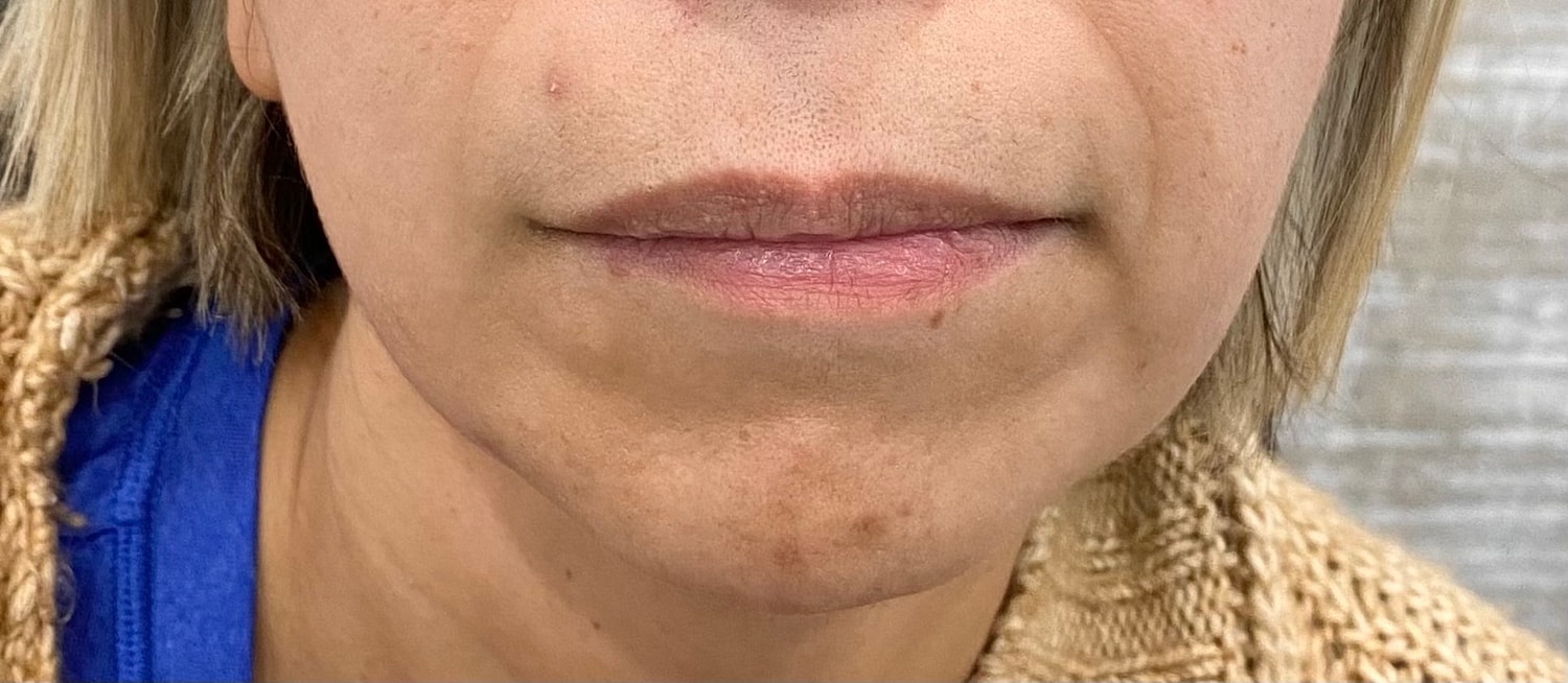 Dermal Fillers Before & After