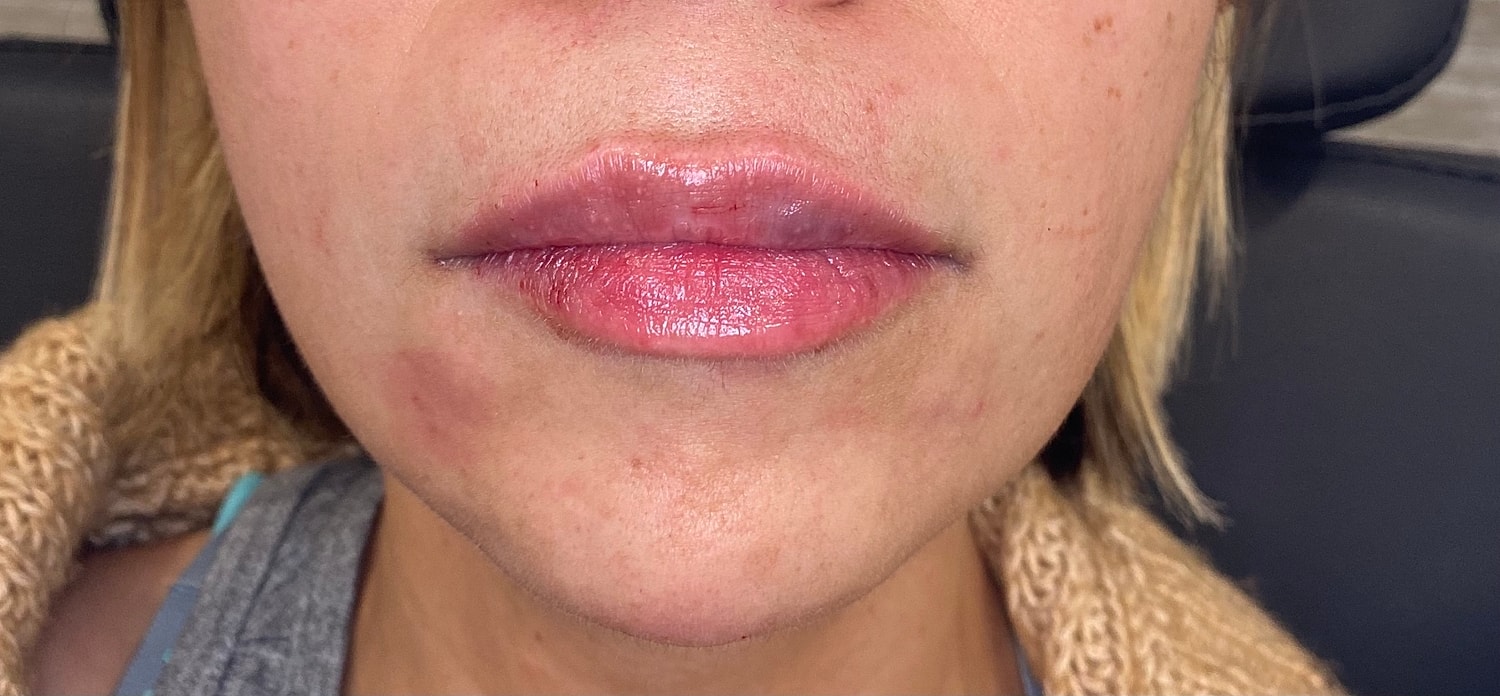 Dermal Fillers Before & After
