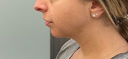 Dermal Fillers Before & After