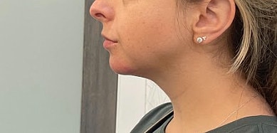 Dermal Fillers Before & After