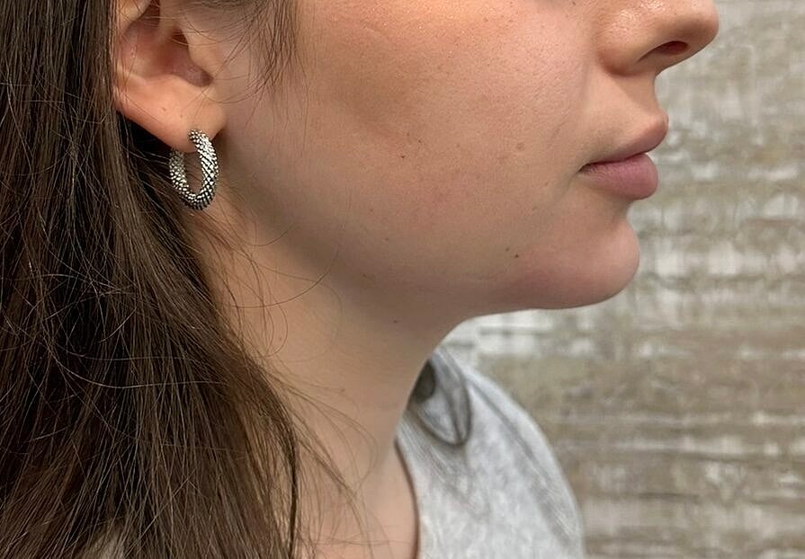 Dermal Fillers Before & After