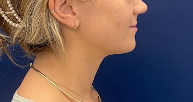 Dermal Fillers Before & After