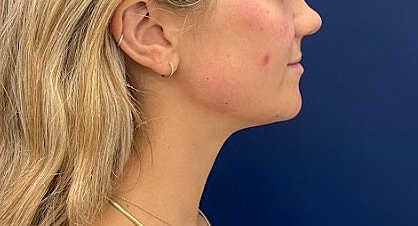 Dermal Fillers Before & After