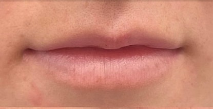 Dermal Fillers Before & After