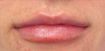 Dermal Fillers Before & After