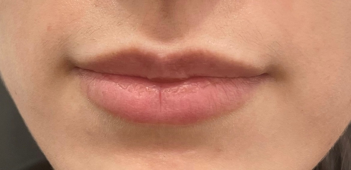 Dermal Fillers Before & After