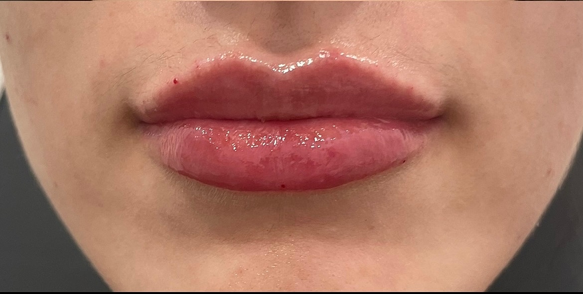 Dermal Fillers Before & After