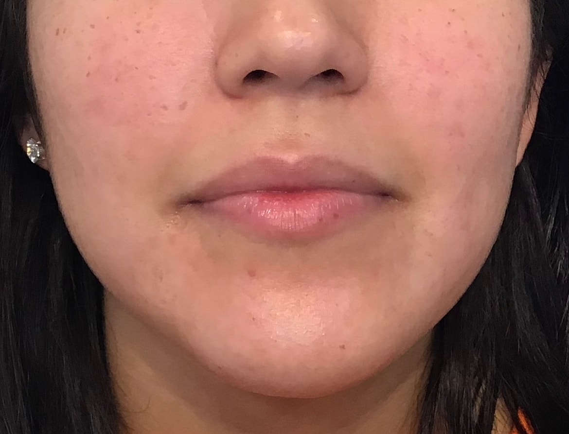 Dermal Fillers Before & After