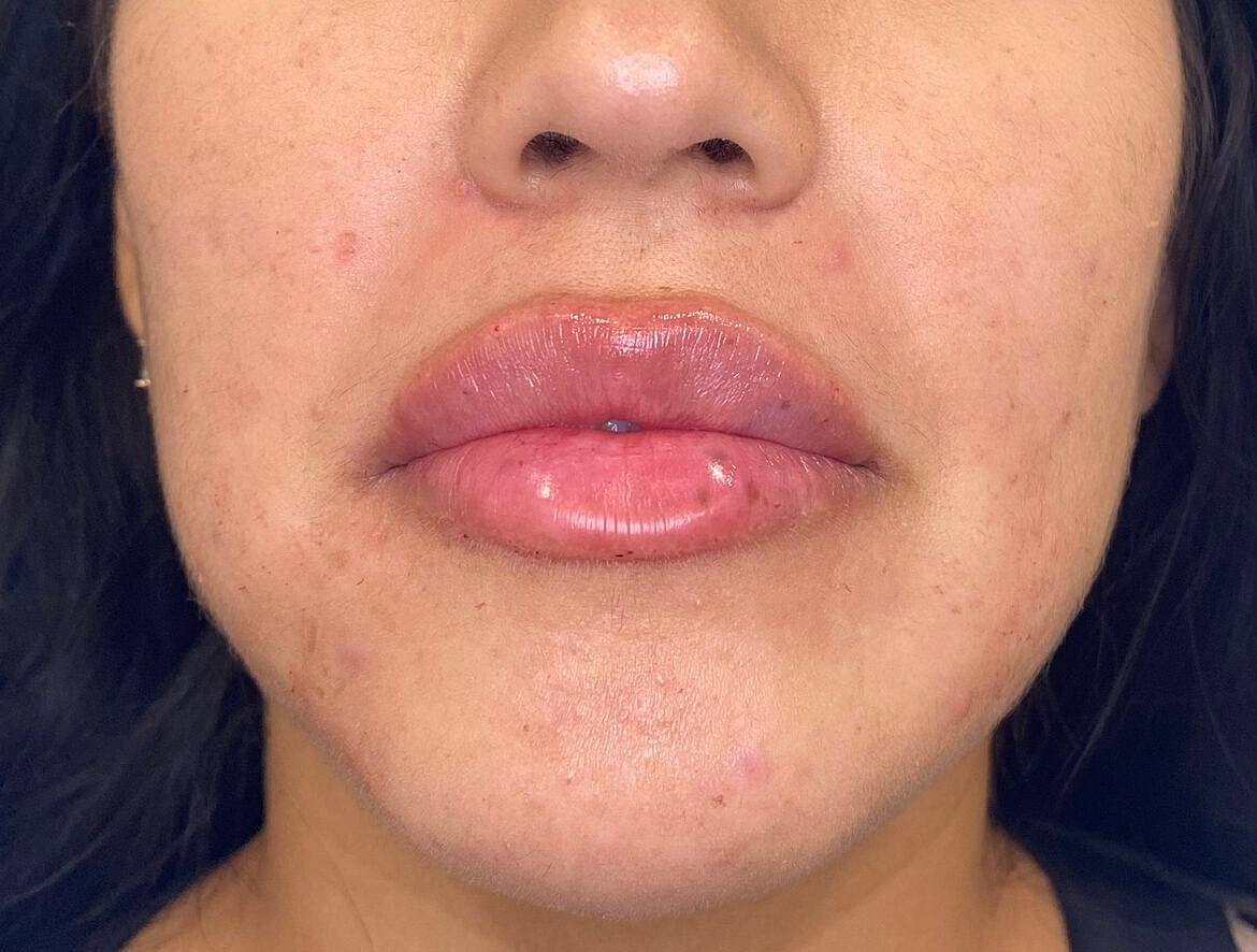 Dermal Fillers Before & After