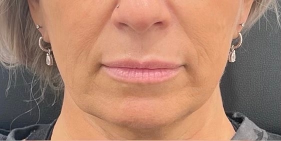 Dermal Fillers Before & After