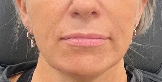 Dermal Fillers Before & After