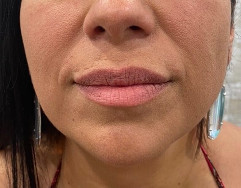 Dermal Fillers Before & After