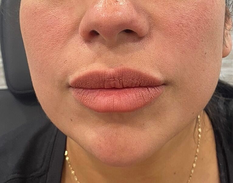 Dermal Fillers Before & After