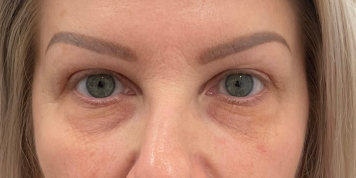 Dermal Fillers Before & After