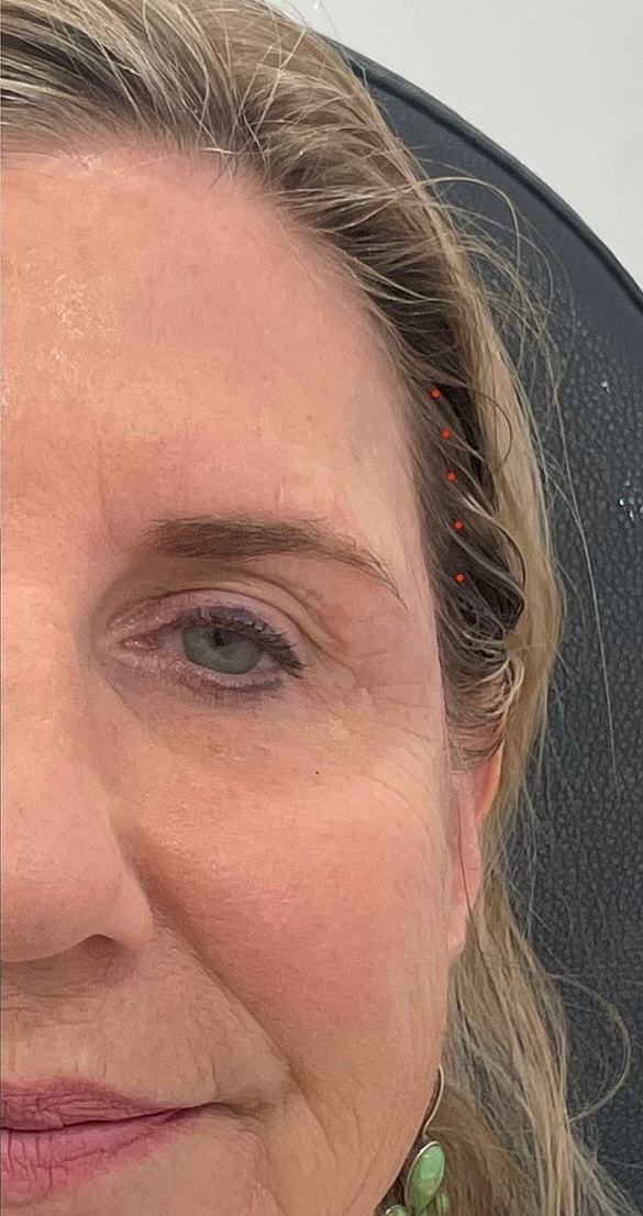 Dermal Fillers Before & After
